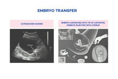 embryo-transfer-diagram